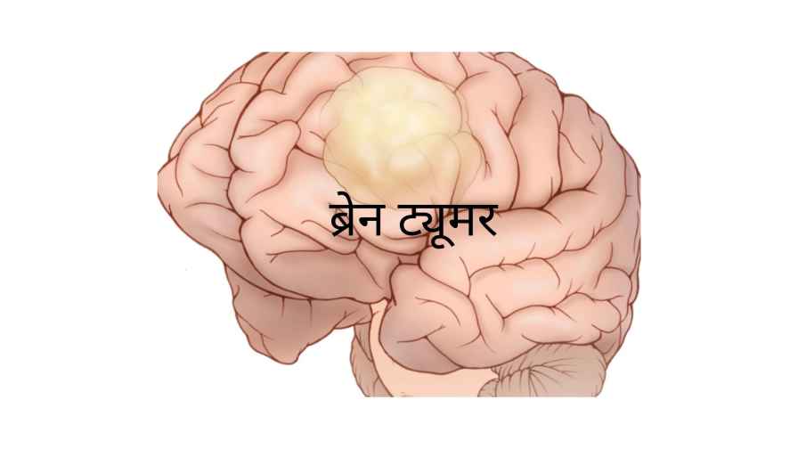 Symptoms of brain tumor in marathi